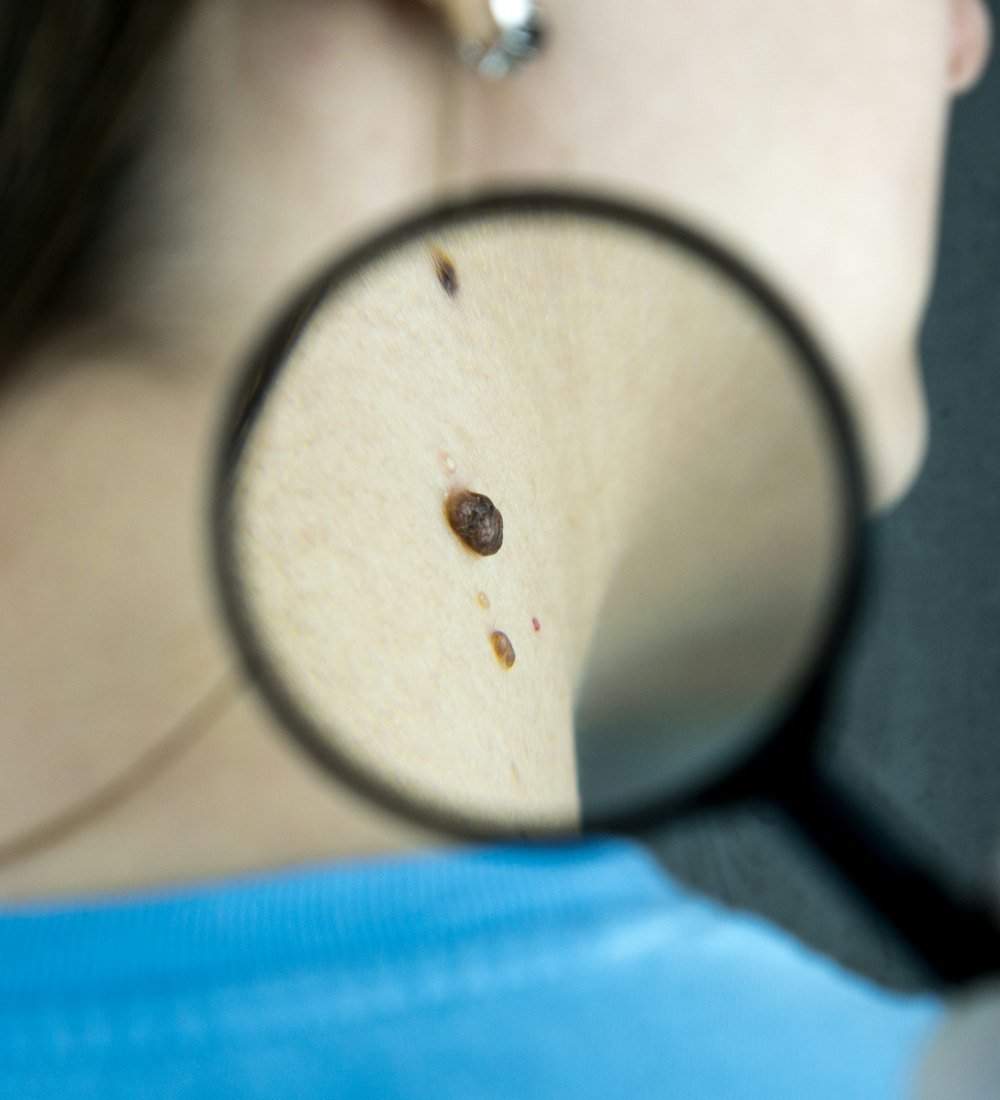 A close-up skin check using a magnifying glass
